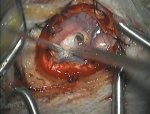 Metastatic brain tumor