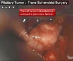 Pituitary Tumor : Trans-Sphenoidal Surgery
