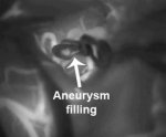 MCA aneurysm 2