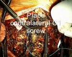 C1 lateral mass fixation