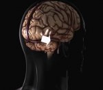 Right facial nerve transposition