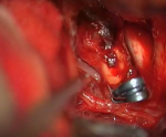 ACoA aneurysm