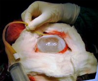 Hydatid cyst of brain