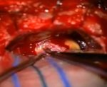AICA/PICA anatomical variants penetrating the dura of subarcuate fossa 