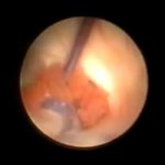 Endoscopic excision of a colloid cyst