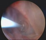 Endoscopic Treatment of Arachnoid Cysts