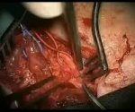 Surgical Technique of Microneurovascular Facial Reanimation Using Masseteric Innervation