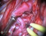 Cingulate gyrus arteriovenous malformation