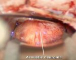Acoustic Neuroma - Neurinoma do Acústico