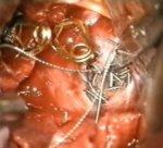 Microsurgical Treatment of Previously Coiled Giant Proximal ICA Aneurysm