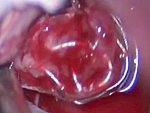A Com Aneurysm previously embolized