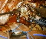 Aneurismas de la Cerebral Media (MCA Aneurysm)
