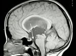 Endoscopic 3rd ventriculostomy 3