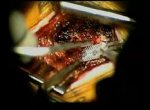 Spinal Cord Stimulation