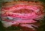 Spinal Cord Ependymomas 