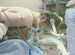 Chiari I Malformation 