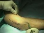 Ulnar nerve neurolysis and transposition