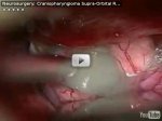 Craniopharyngioma 2