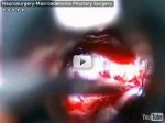 Macroadenoma Pituitary Surgery