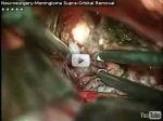 Meningioma Supra-Orbital Removal
