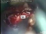 ACTH pituitary adenoma