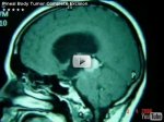Pineal Body Tumor 