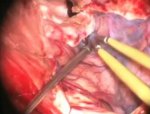 Meningioma da Clinoide Anterior