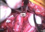 Thoracic outlet syndrome - decompression