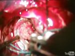 Intraventricular tumor 