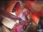 Right PCA Aneurysm