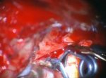 Posterior communicating artery aneurysm