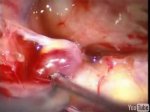 Anterior choroidal artery aneurysm