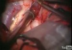 Anterior communicating artery aneurysm
