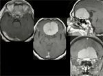 Olfactory groove meningioma 2