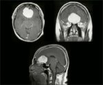 Olfactory groove meningioma 3