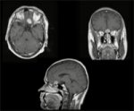 Olfactory groove meningioma 4