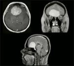 Olfactory groove meningioma 5