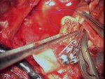 Vascular clamp-assisted clipping of giant aneurysm