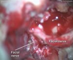 Petroclival meningioma 2