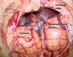 Pineal tumor 1