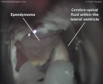 Intraventricular ependymoma 