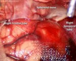 MCA aneurysm 1