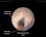 Endoscopic 3rd ventriculostomy 2