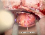 Acoustic neuroma