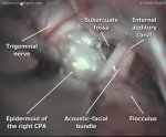 PCA epidermoid 