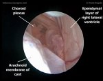 Arachnoid endoventricular cyst 