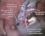 Carotid bifurcation aneurysm 