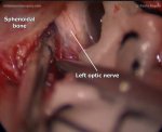 MCF meningioma (Left subtemporal-pterional approach)