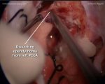 Recurrent 4th ventricle ependymoma 