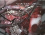 Olfactory groove meningioma 1